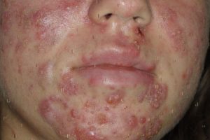 acne conglobata visage